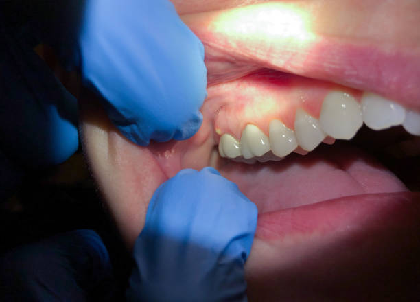 Best Emergency Treatment for Dental Infections or Abscesses in Edgewood, PA